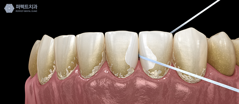 치실, 치간칫솔 사용법! 관련 이미지 3