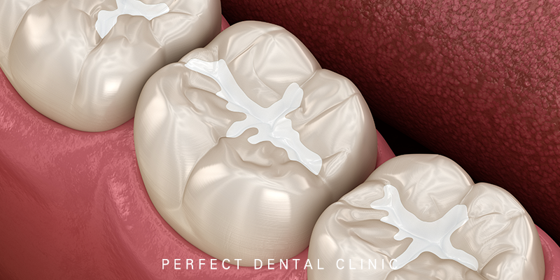 충치치료 단계와 치료방법 관련 이미지 2