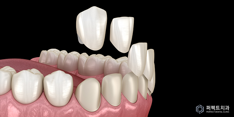앞니 올세라믹 크라운 교체 관련 이미지 1
