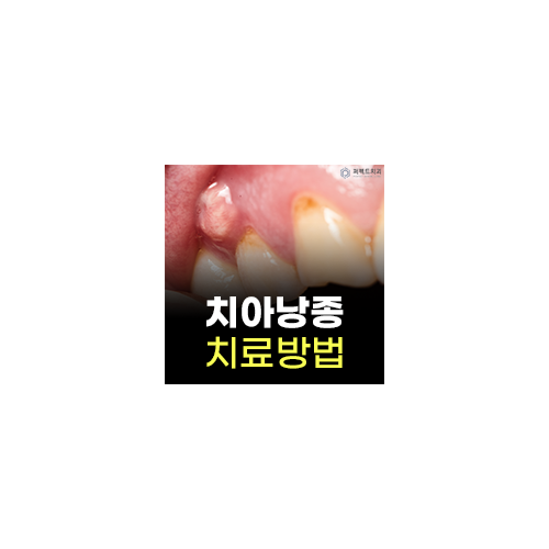 치아낭종 종류와 치료법 관련 이미지 3