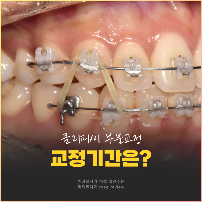 클리피씨를 이용한 부분교정, 얼마나 걸릴까? 관련 이미지 1