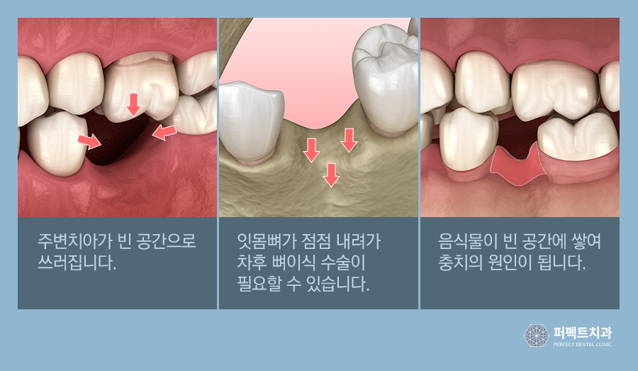 임플란트 시 가장 많이 하는 질문 Best 관련 이미지 6
