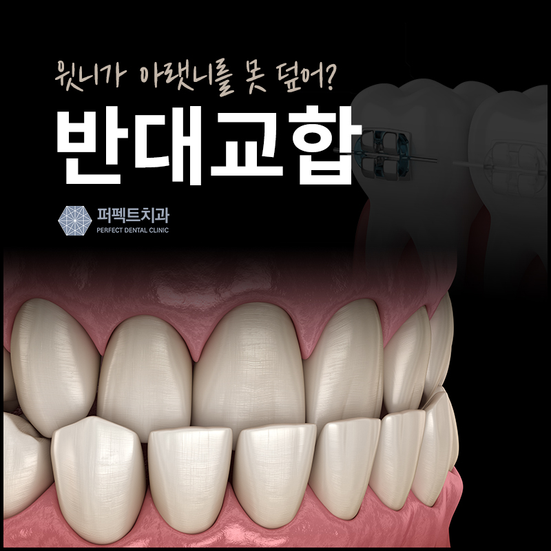 반대교합 비수술 교정 결과는? 관련 이미지 1