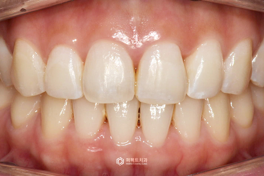 나비치아, 부분교정vs라미네이트 치과의사가 추천하는 방법은? 관련 이미지 5