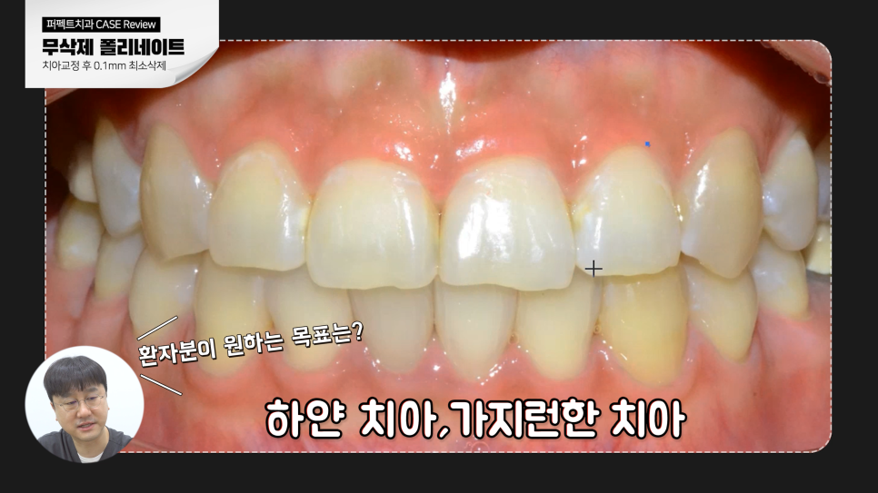 "앞니가 깨졌어요" 무삭제 라미네이트 치료CASE 관련 이미지 2