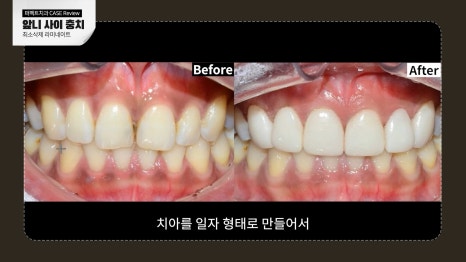 앞니 사이 충치치료와 폴리네이트 관련 이미지 8