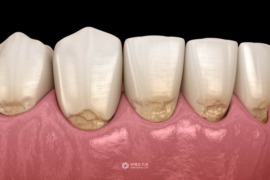 치아가 시린 다양한 이유! 관련 이미지 2