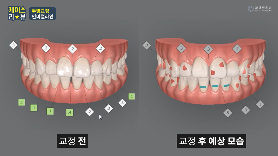 인비절라인 효과 알아보기 (+인비절라인라이트) 관련 이미지 10
