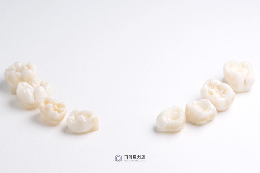 라미네이트 시 임시치아를 해야 하는 이유와 주의사항은? 관련 이미지 2