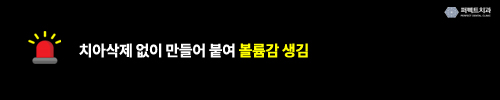 무삭제라미네이트 치료의 문제점? 관련 이미지 3