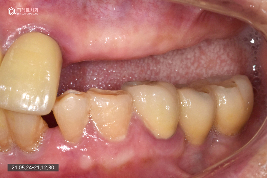 치아가 하나도 없을 때 필요한 전악임플란트😬 관련 이미지 4