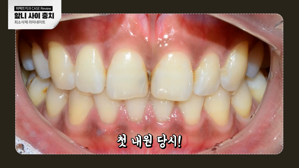 앞니 사이 충치, 어떻게 치료해야 티 안 날까? 관련 이미지 2