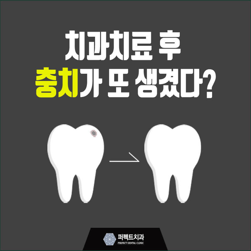 치과치료 후 충치가 또 생겼다면? 관련 이미지 1