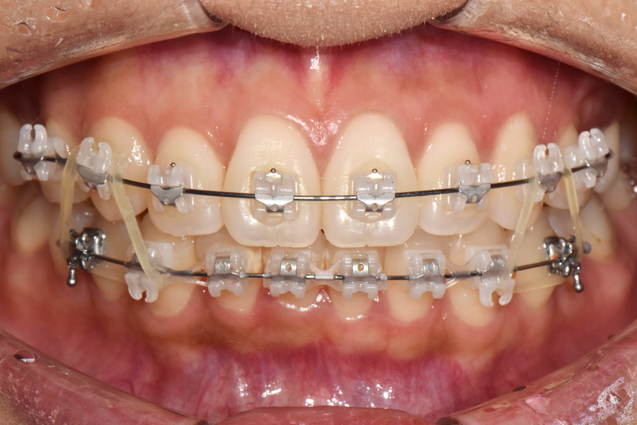 클리피씨를 이용한 부분교정, 얼마나 걸릴까? 관련 이미지 5