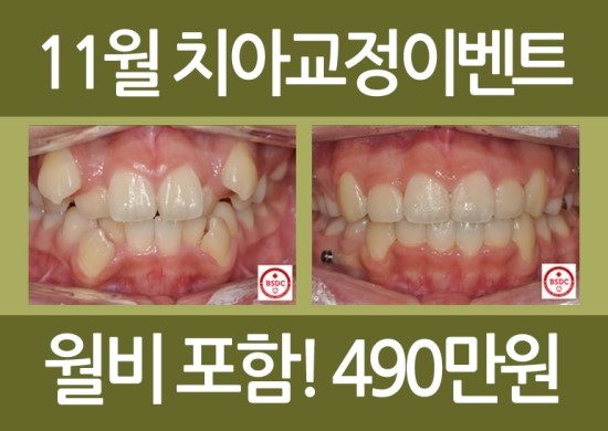 [교정치료]치아교정이벤트 관련 이미지 6