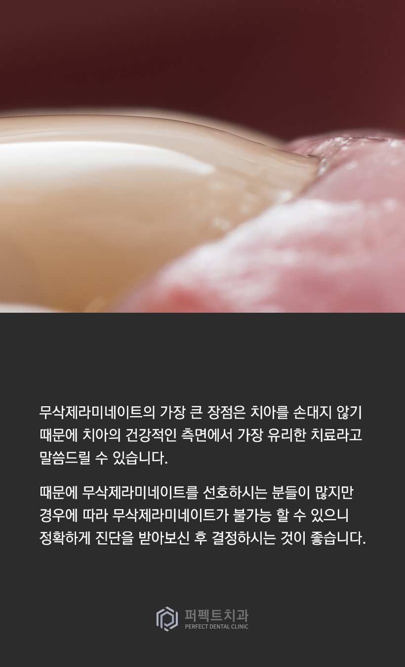 무삭제라미네이트 vs 일반라미네이트 수명에 차이가 있나요? 관련 이미지 4