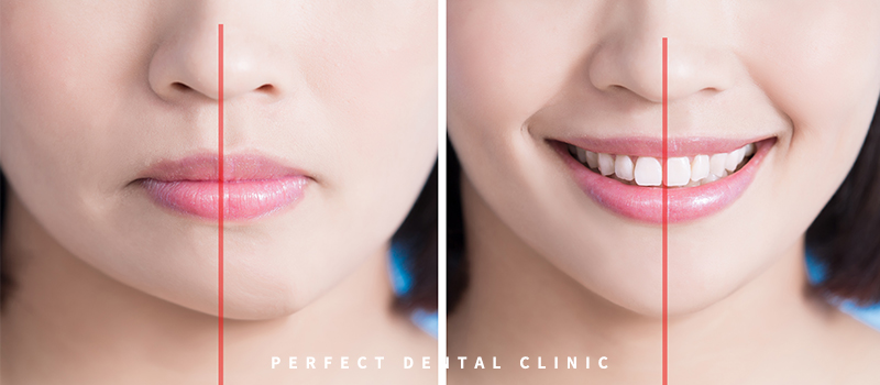 얼굴비대칭 비수술교정, 결과는? 관련 이미지 1