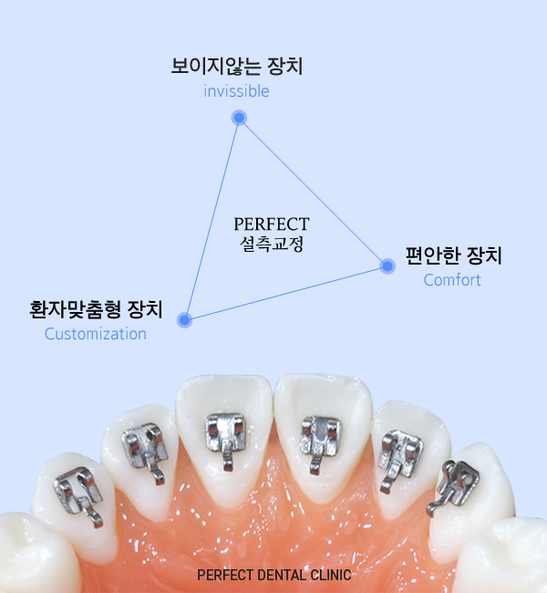 치아안쪽에 교정하는 설측교정! 관련 이미지 1