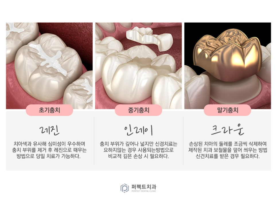 미룰수록 어려운 충치치료, 초기에 치료해요! 관련 이미지 4