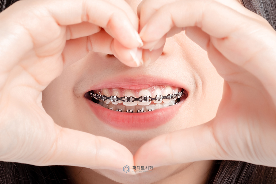치아교정 미니스크류|꼭 심어야되나요?, 통증은? 관련 이미지 1