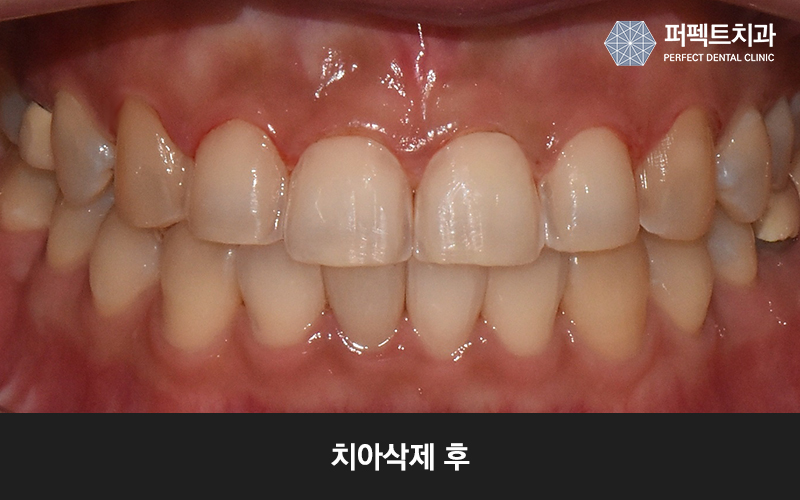 앞니 라미네이트 치아삭제량 확인해보세요! 관련 이미지 5