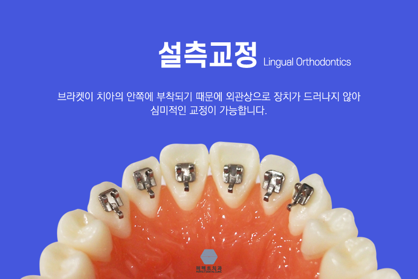 치아안쪽에 하는 설측교정^^ 관련 이미지 2