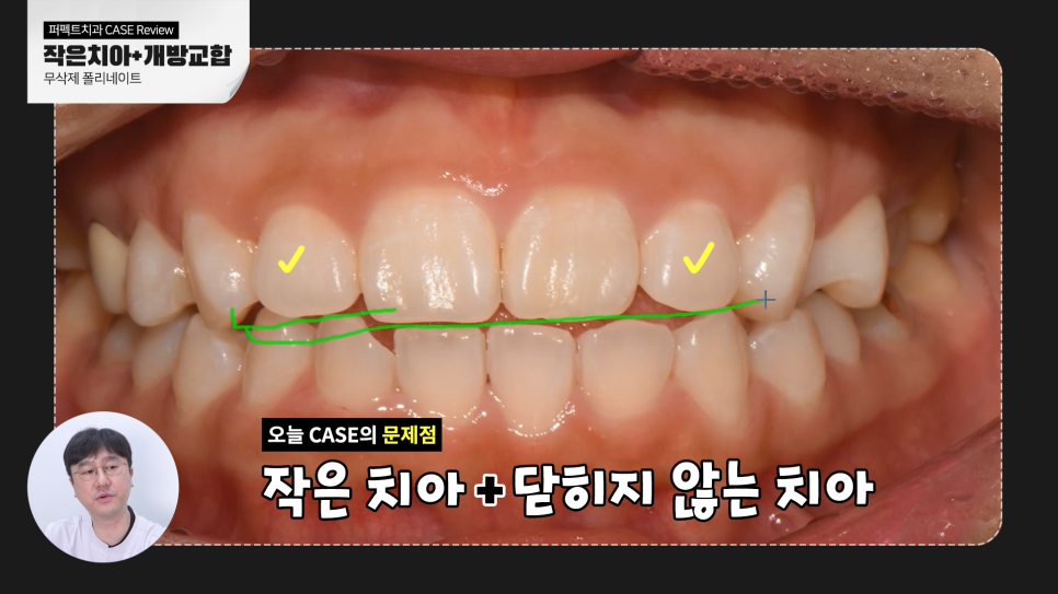 왜소치와 개방교합 문제를 한 번에 개선하다. 관련 이미지 2