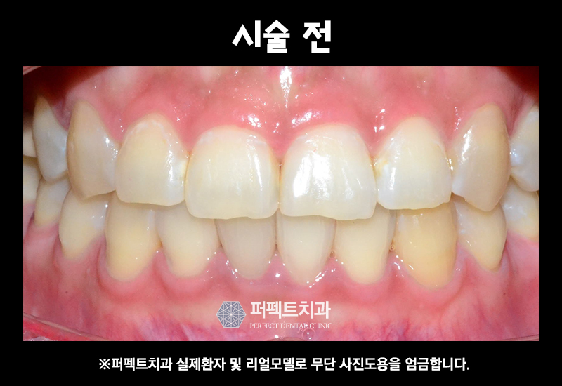 앞니 라미네이트 관련 이미지 5