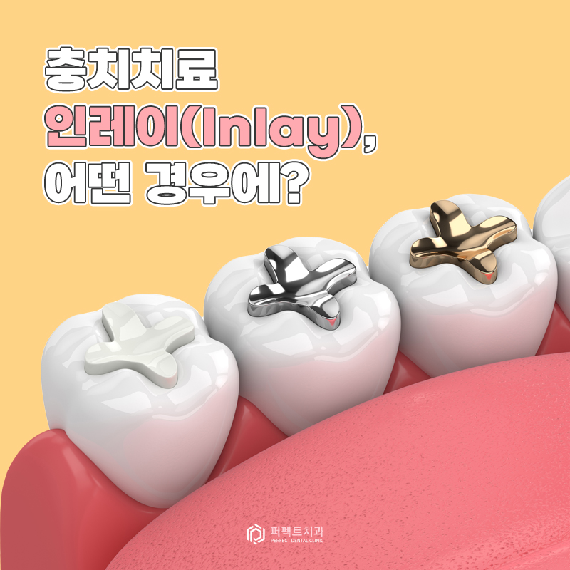 충치치료 인레이, 어떤 경우에? 관련 이미지 1