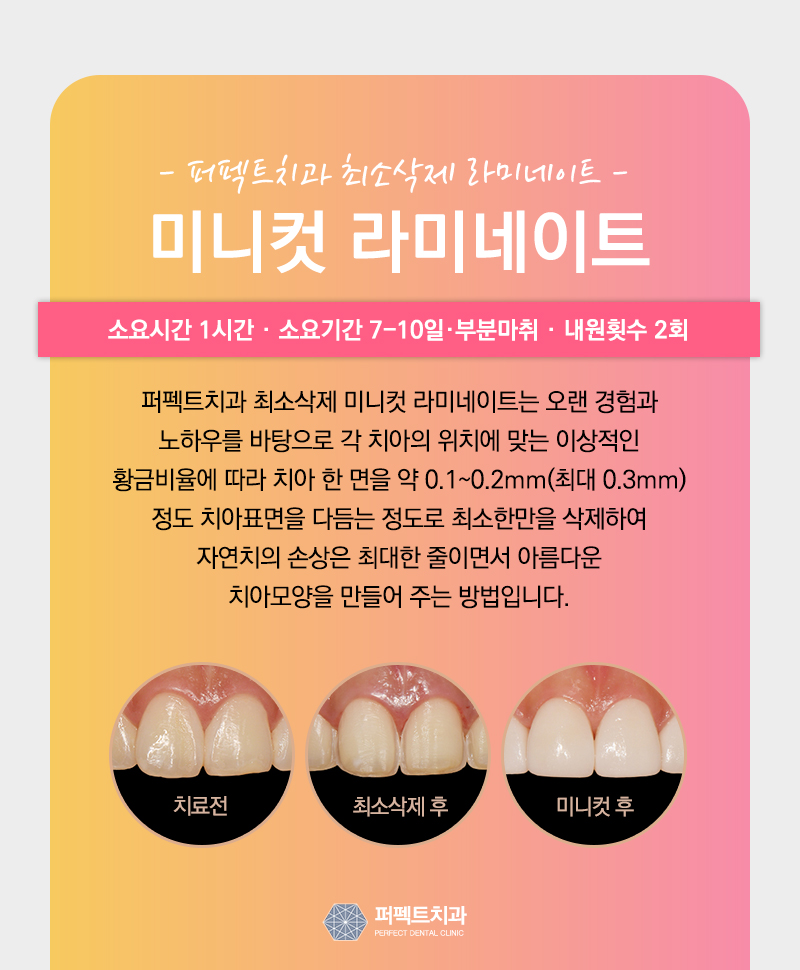 라미네이트 부작용 왜 나타나는 건가요? 관련 이미지 7