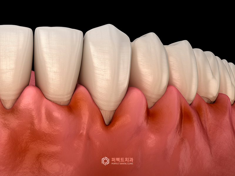 #1탄_의료보험 적용되는 치과치료는?(스케일링편) 관련 이미지 3