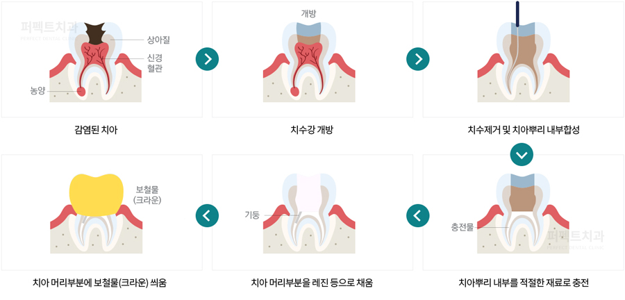 치아에 씌운 크라운 보철, 이런 경우 크라운교체가 필요하다! 관련 이미지 3