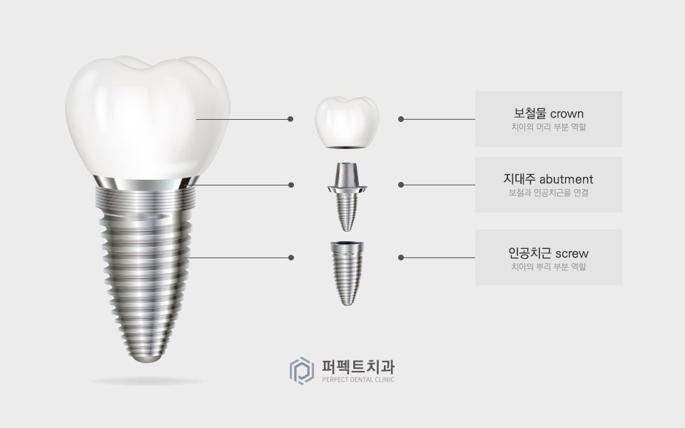 컴퓨터 분석을 통한 임플란트 관련 이미지 5