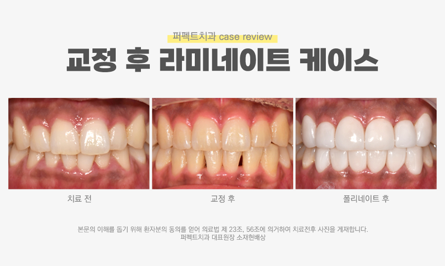 삐뚠 치아도 최소삭제가 가능하게👌🏻 교정 후 폴리네이트 관련 이미지 10