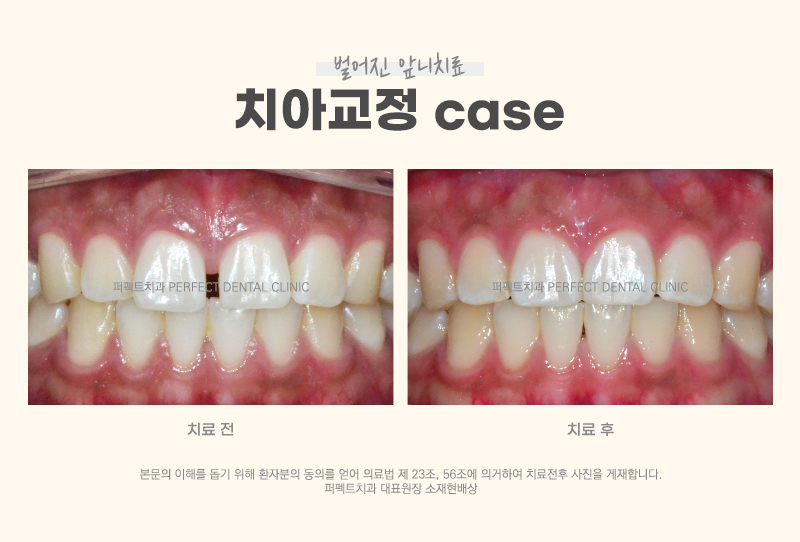 벌어진 앞니를 치료하는 다양한 방법 관련 이미지 2