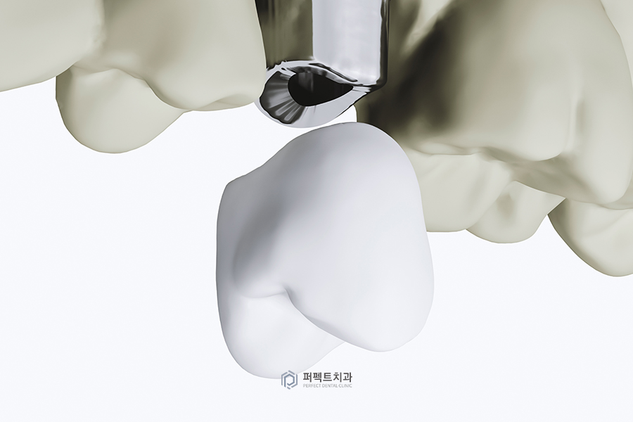임플란트 보철 탈락②｜크라운이 빠지는 이유, 두 번째 관련 이미지 2