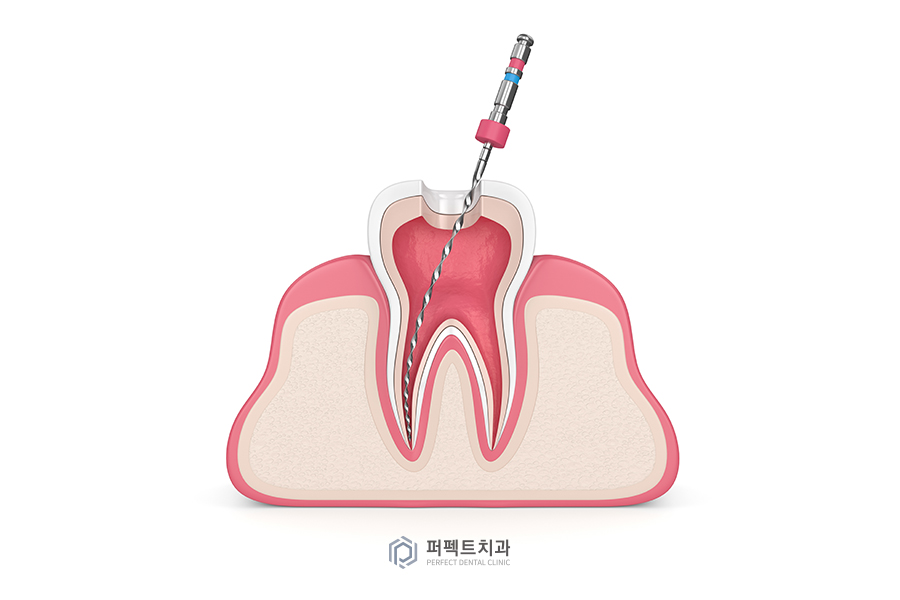 신경치료란 무엇일까요? 관련 이미지 3