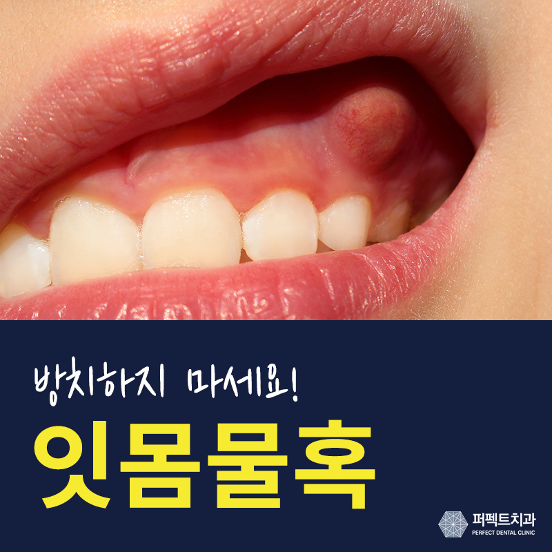 잇몸물혹 방치하게 되면? 관련 이미지 1