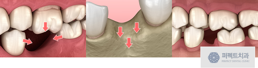 빠진 치아, 그대로 둔다면?임플란트수술 관련 이미지 2