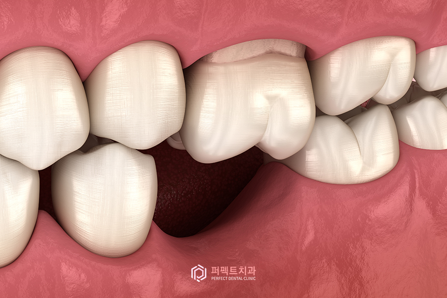 임플란트도 나이 제한이 있다?① - 학생편 관련 이미지 3