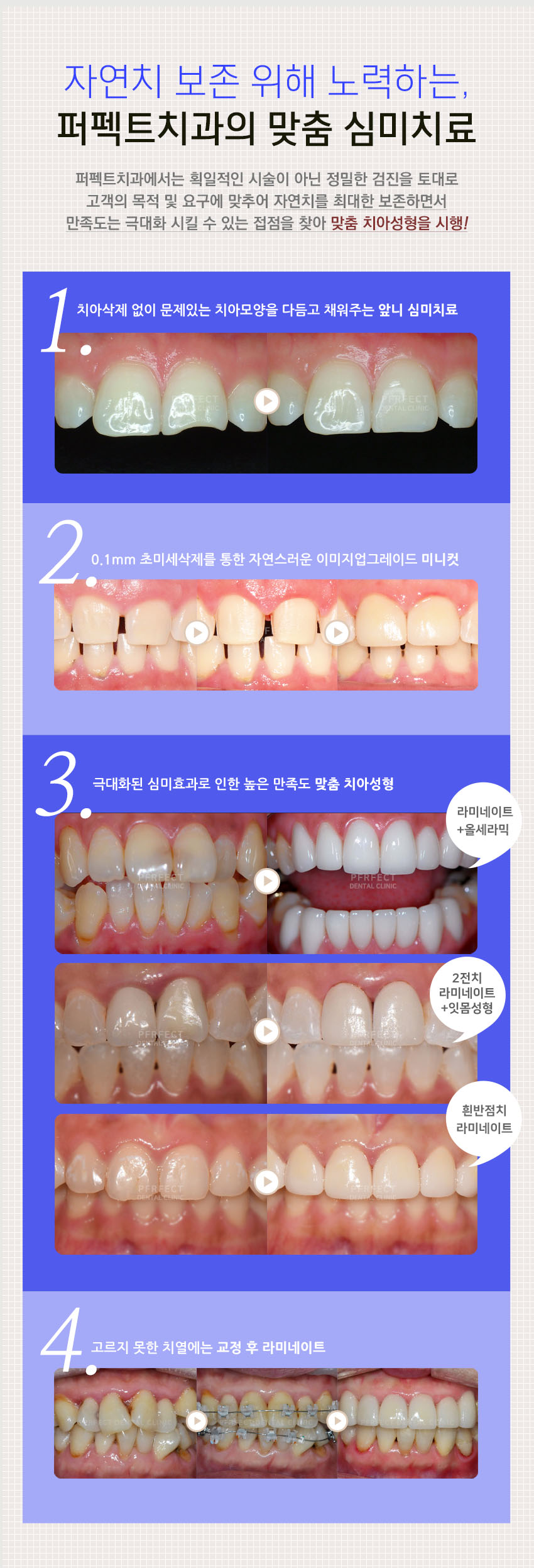 잃어버린 미소를 되찾는 치아성형! 관련 이미지 3