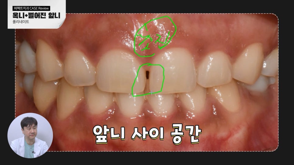 벌어진앞니 무삭제라미네이트 케이스 관련 이미지 2