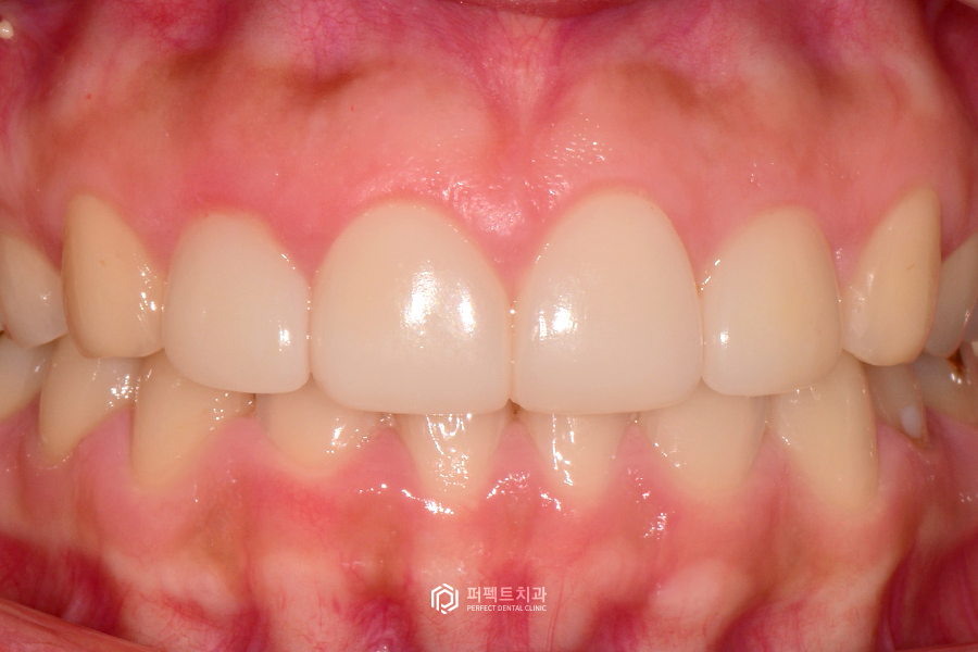 3일만에 라미네이트 교체를 결정한 이유는?😲 관련 이미지 2