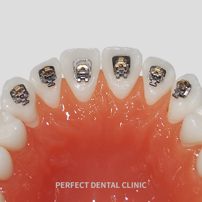 콤비교정&설측교정 비용&hearts; 관련 이미지 11