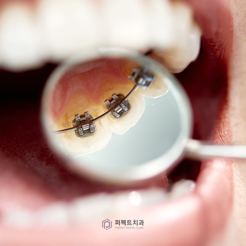 라미네이트 후 치아교정 시 알아아야 할 점은? 관련 이미지 2