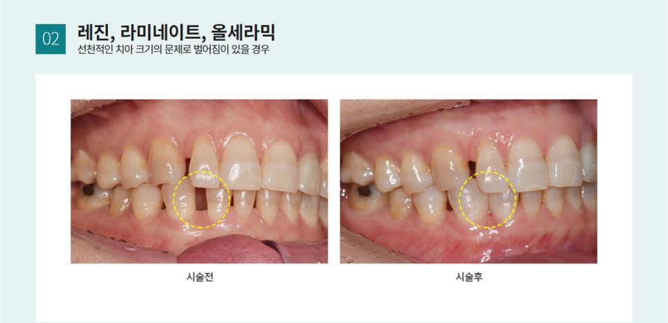 벌어진 치아, 무조건 교정을 해야한다? 관련 이미지 4