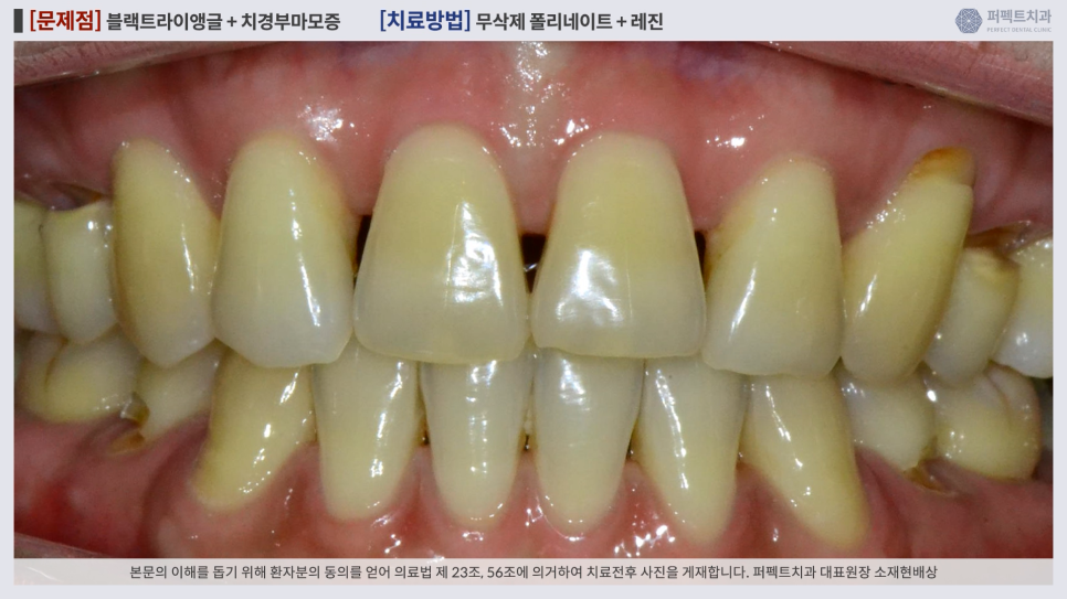 앞니 사이 틈, 블랙트라이앵글 치료방법 어렵지 않아요. 관련 이미지 3