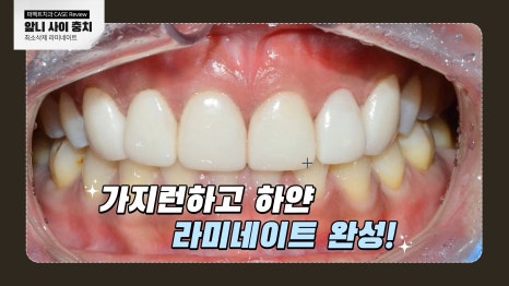 앞니 사이 충치치료와 폴리네이트 관련 이미지 9