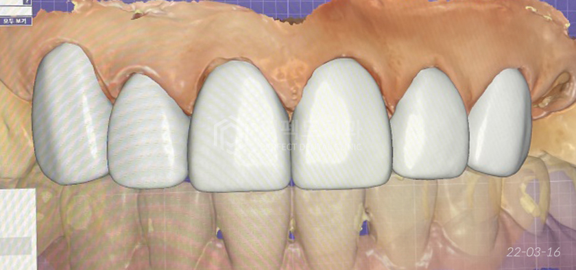 라미네이트를 뜯어보니😨..충격주의 #앞니신경치료 관련 이미지 4