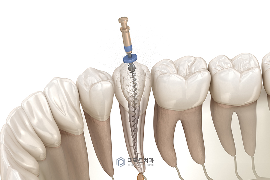 ✨신경치료 질문 BEST② 관련 이미지 2